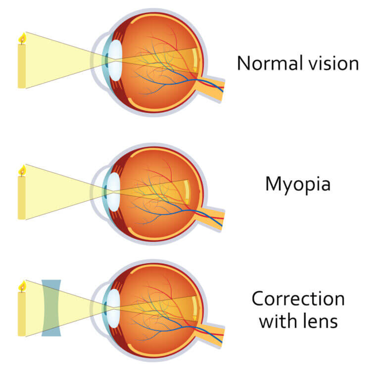 Diagram of Myopia